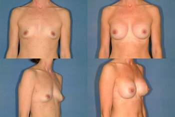 Breasts. Foto: wikipedia.org