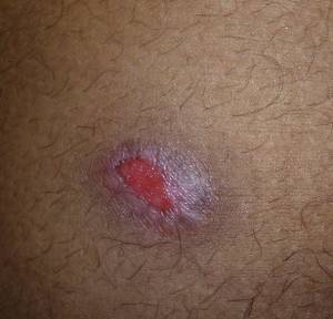 One of the sores.
